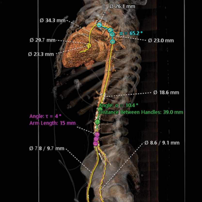 CT-aorta-2-1