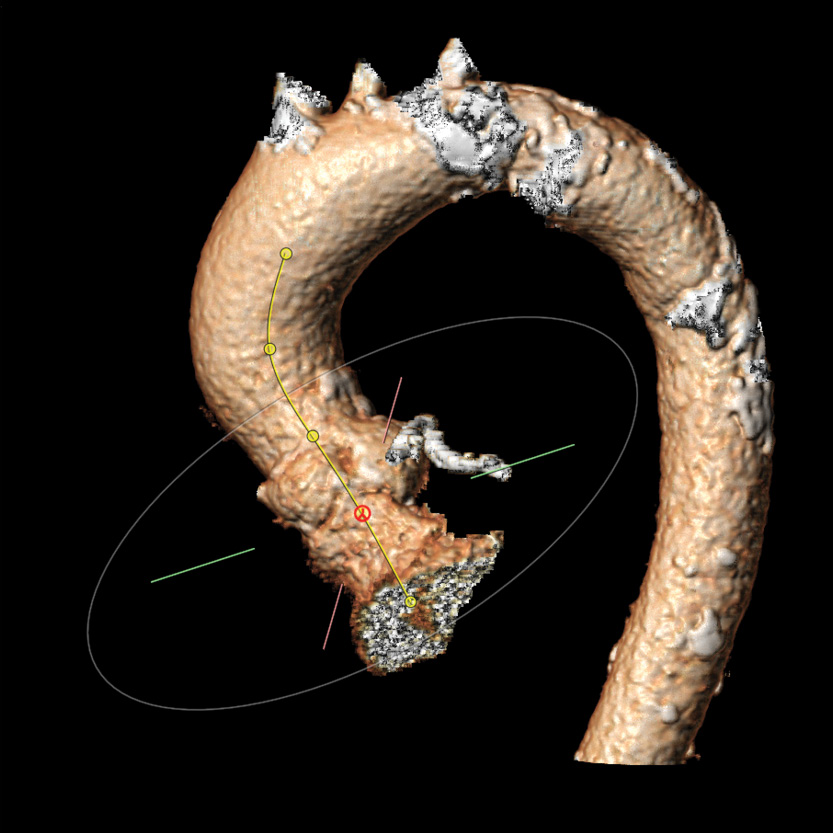 TAVR-2